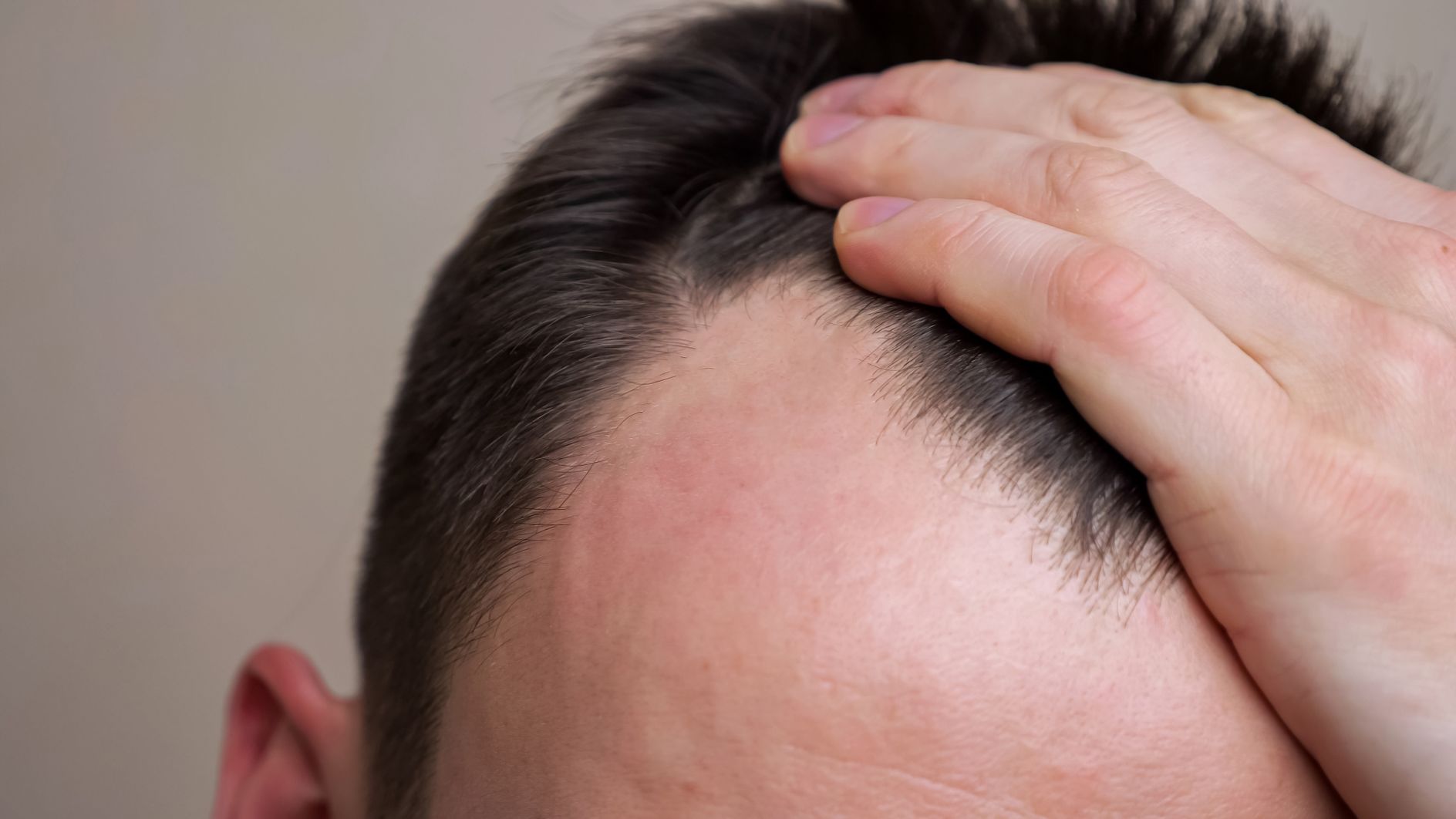 Tratamento queda de cabelo em Curitiba 33