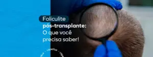 Foliculite após um transplante capilar: Informações essenciais que você deve conhecer! 23